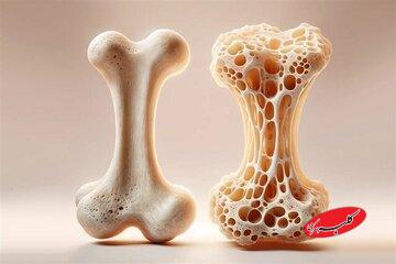 ویتامین‌های مفید برای تقویت استخوان