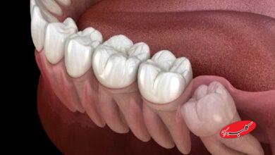 بیماری لثه خطر سکته مغزی را افزایش می دهد