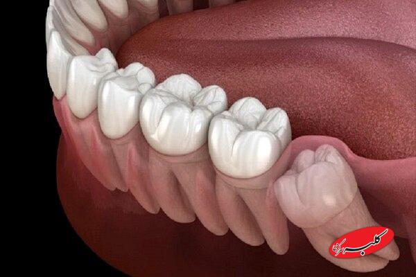 بیماری لثه خطر سکته مغزی را افزایش می دهد