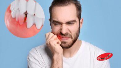 بهداشت دندان - دندانپزشکی - پوسیدگی دندان