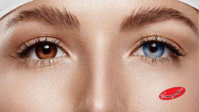 جراحی تغیی رنگ چشم - رنگ عنبیه