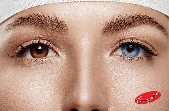 جراحی تغیی رنگ چشم - رنگ عنبیه