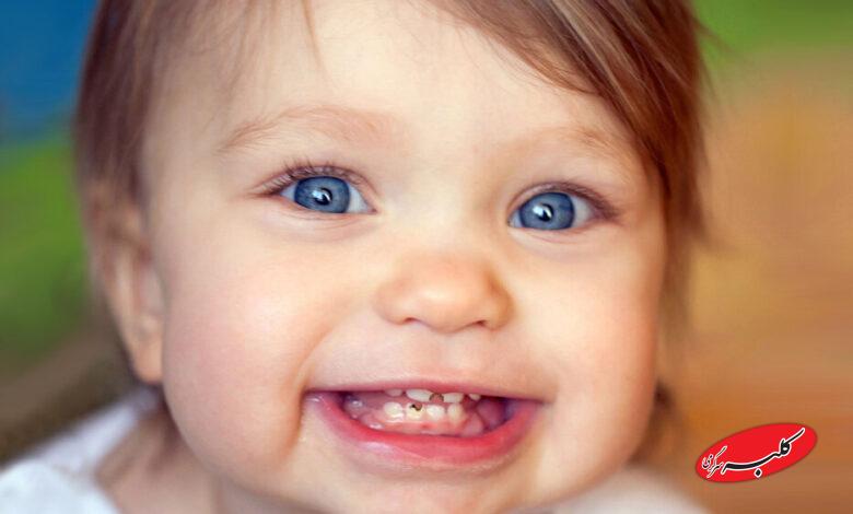 پوسیدگی دندان در کودکان