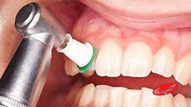 جرم‌گیری دندان