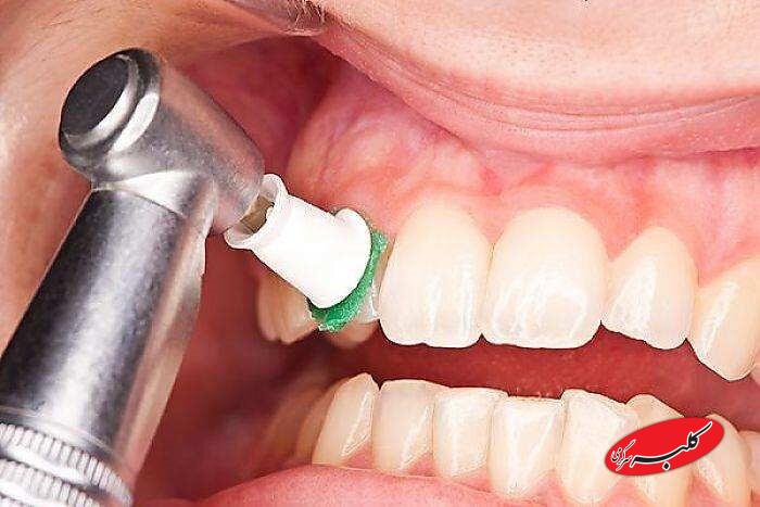 جرمگیری دندان