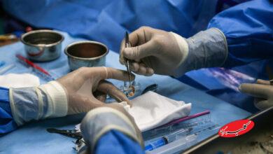 پیوند قرنیه