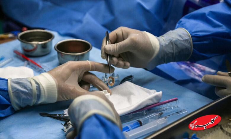 پیوند قرنیه