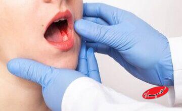 اصلی‌ترین عوامل خطر در سرطان دهان چیست؟/ علائم هشدار دهنده