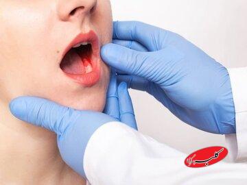 اصلی‌ترین عوامل خطر در سرطان دهان چیست؟/ علائم هشدار دهنده