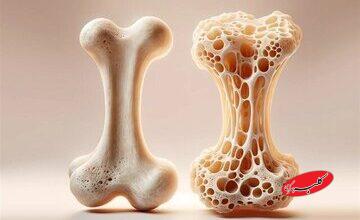 تقویت استخوان‌ها با مصرف این ویتامین‌ها