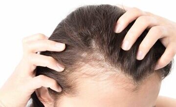 چهار توصیه مهم برای کسانی که ریزش مو دارند