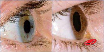 آیا استفاده مداوم از موبایل و لپتاپ باعث قوز قرنیه میشود؟