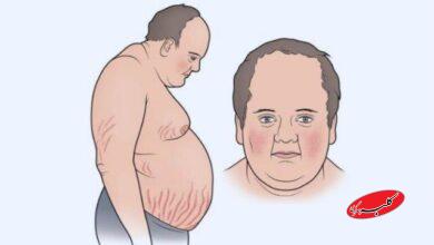 سندرم کوشینگ