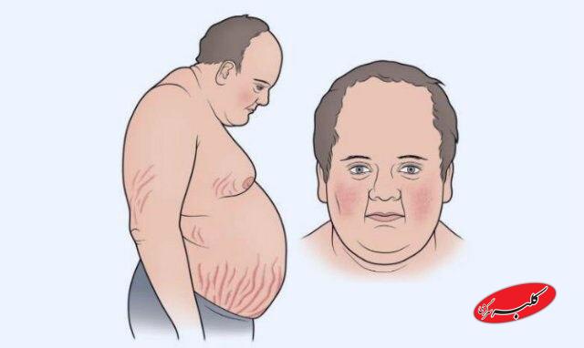 سندرم کوشینگ