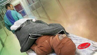 کمبود هزار تخت بیمارستانی سوختگی در کشور