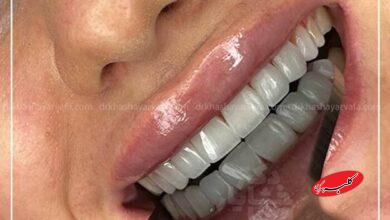چطور کامپوزیت دندان در کمتر از یک جلسه لبخندتان را تغییر میدهد؟