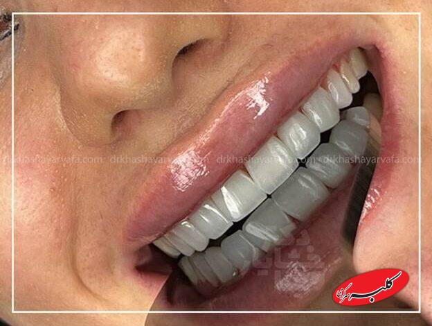 چطور کامپوزیت دندان در کمتر از یک جلسه لبخندتان را تغییر میدهد؟