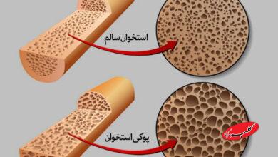 پوکی استخوان