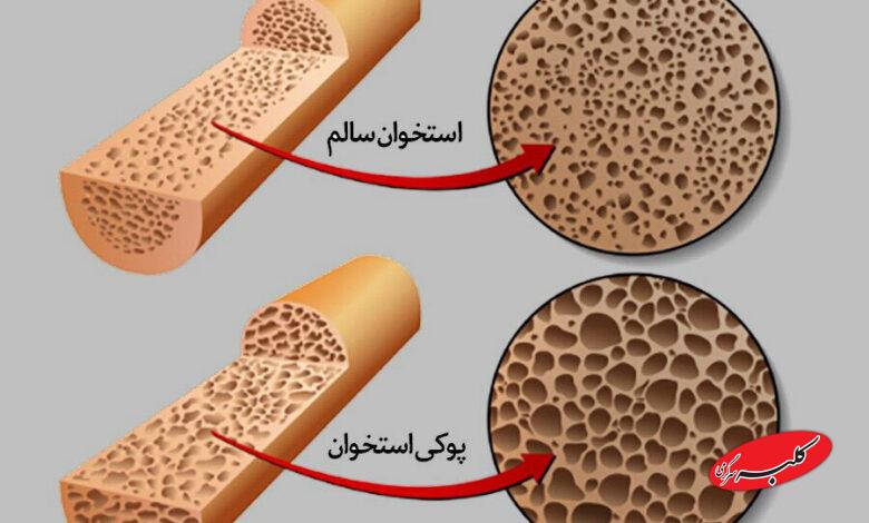 پوکی استخوان