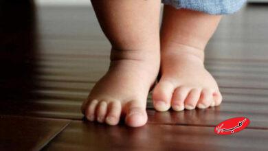 کف پای صاف در کودک