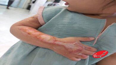 توصیههایی برای پیشگیری از سوختگی