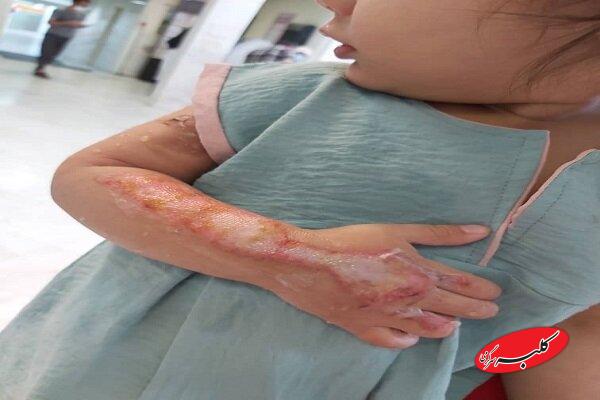 توصیههایی برای پیشگیری از سوختگی