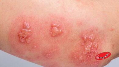 ویژگیهای خاص واکسن زونا