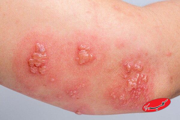 ویژگی‌های خاص واکسن زونا