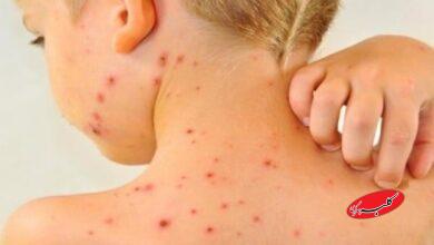 افزایش موارد ابتلا به سرخک در جهان با کاهش میزان واکسیناسیون