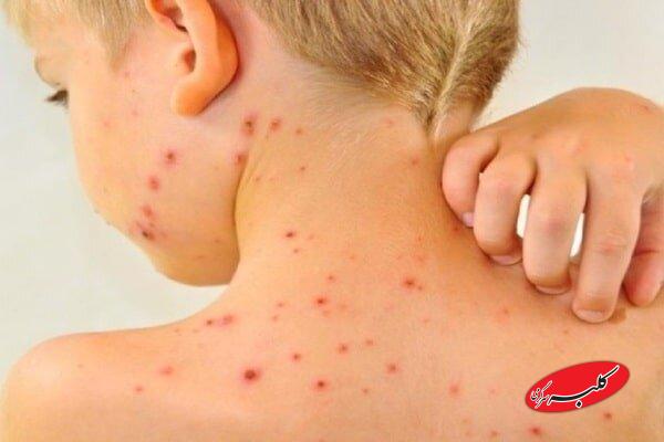 افزایش موارد ابتلا به سرخک در جهان با کاهش میزان واکسیناسیون