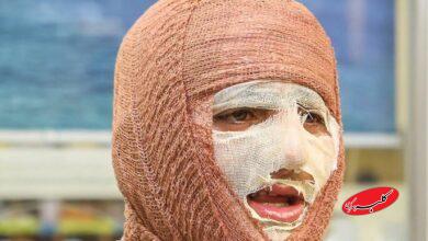 جلالی: سالانه حدود ۳۰۰ هزار نفر به مراکز سوختگی کشور مراجعه میکنند