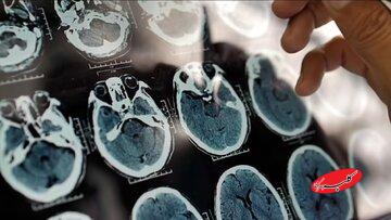 یک عامل مهم و کمتر گفته شده درباره روند پیشرفت آلزایمر