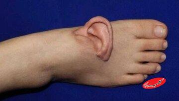 نجات لاله گوش زن چینی با پیوند موقت روی پا