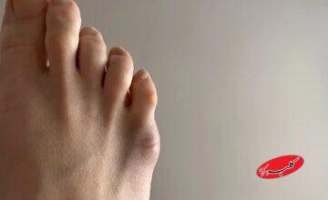 وظیفه بزرگِ انگشت کوچک پا / اگر نباشد چه میشود؟