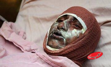 میزان سوختگی در ایران ۸ برابر میانگین جهانی/کارگران ساختمانی بیشترین قربانیان برق گرفتگی