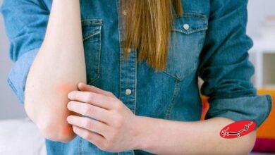 بیماری پوستی پسوریازیس