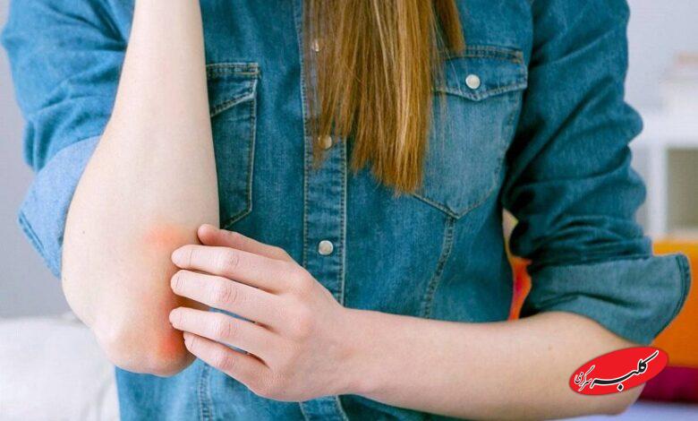 بیماری پوستی پسوریازیس