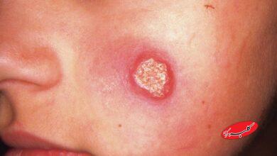 بیماری سالک