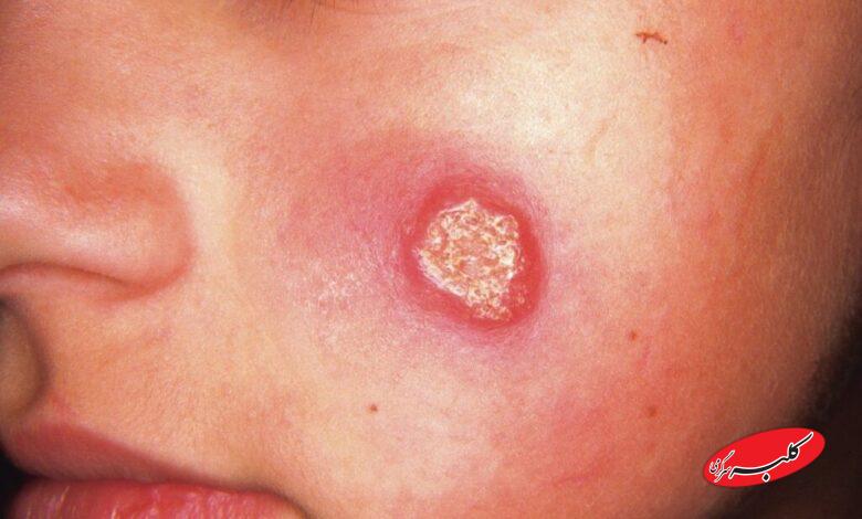 بیماری سالک