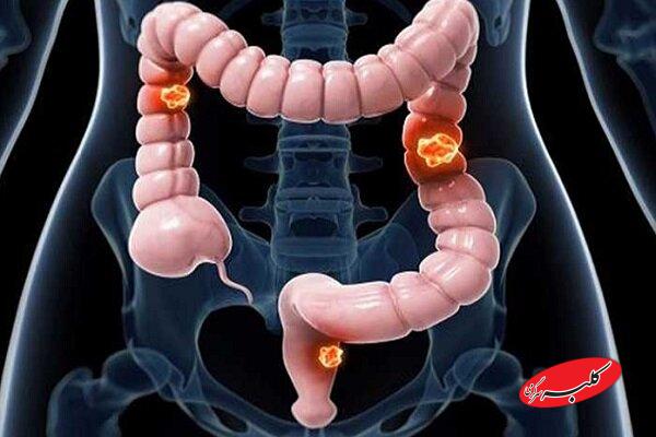 عوامل ابتلا به سرطان روده بزرگ را بشناسیم