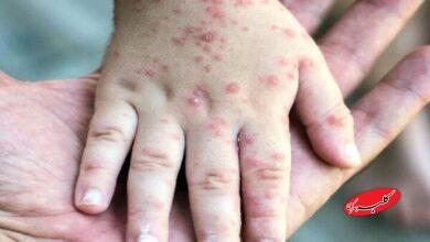 ثبت ۷۱۴ مورد «سرخک» در کشور؛ اوج ابتلا در اردیبهشت