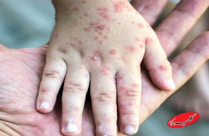 ثبت ۷۱۴ مورد «سرخک» در کشور؛ اوج ابتلا در اردیبهشت