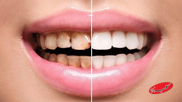 پوسیدگی دندان