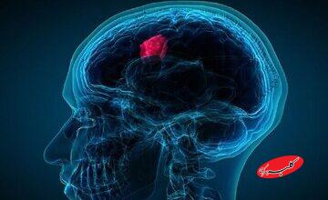 ۷ علامت هشداردهنده تومور مغزی/ این نشانهها را جدی بگیرید