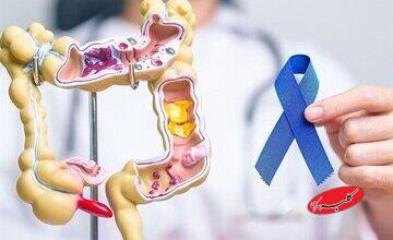 یافتههای جدید درباره پیشگیری از سرطان روده