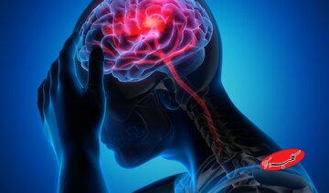 سبقت مردان از زنان در سکته مغزی/ زمان طلایی درمان را جدی بگیرید