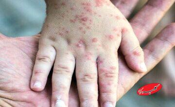 زنگ خطر بازگشت یک بیماری در کشورهای اروپایی