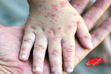 زنگ خطر بازگشت یک بیماری در کشورهای اروپایی