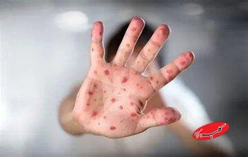 اروپا درگیر موج تازه سرخک