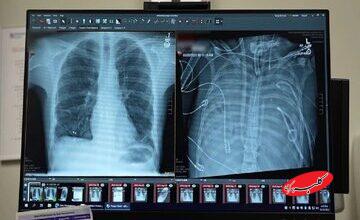 مردی ۴۸ ساعت بدون ریه زنده ماند